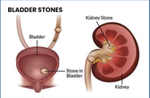 bladder stone