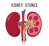 kidney Stone