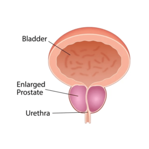 prostate enlargement